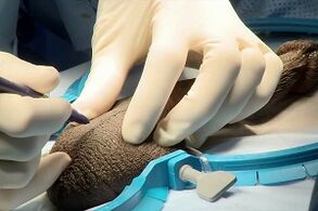 Cerrahi penis büyütme için sivrisinek kesiği