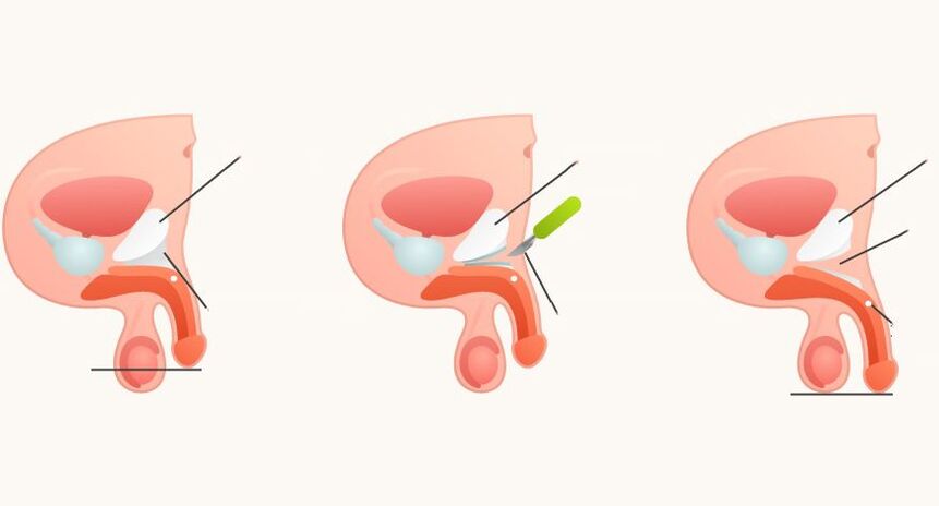 Penis büyütme için ligamentotomi